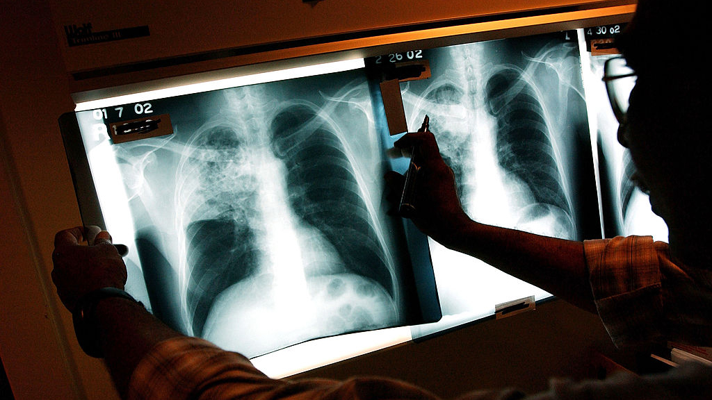2 active tuberculosis cases traced to San Francisco strip club — KTVU FOX 2 Bay Area, Portola Valley Health news